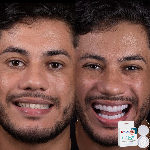 BeautySmile - Facetas Dentárias Removíveis