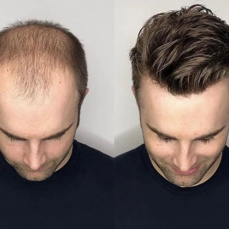 Prótese Capilar Masculina - NewHair